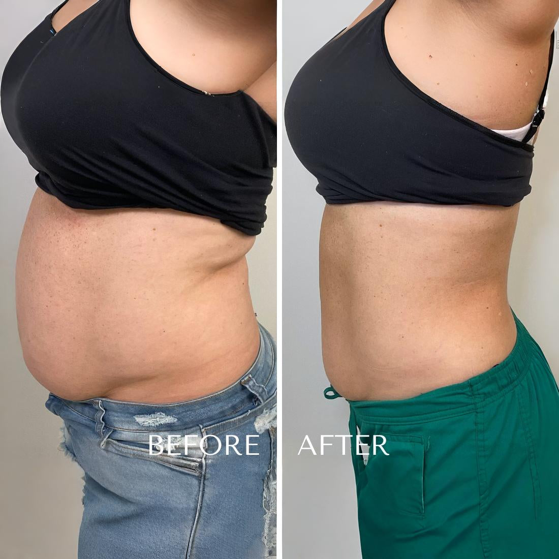 Lipo shots pcdc Body