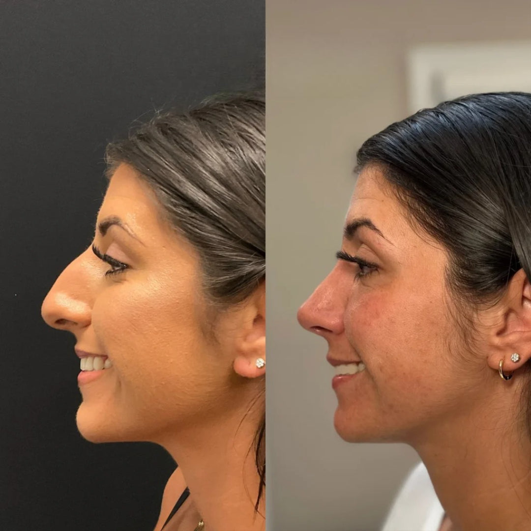 Rhinoplasty – Nose Reshaping & Refinement