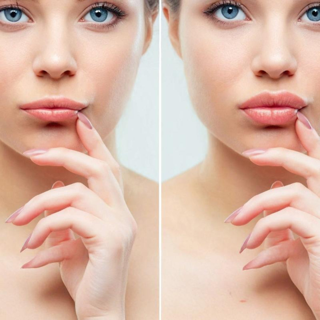 Russian Lip Filler Technique