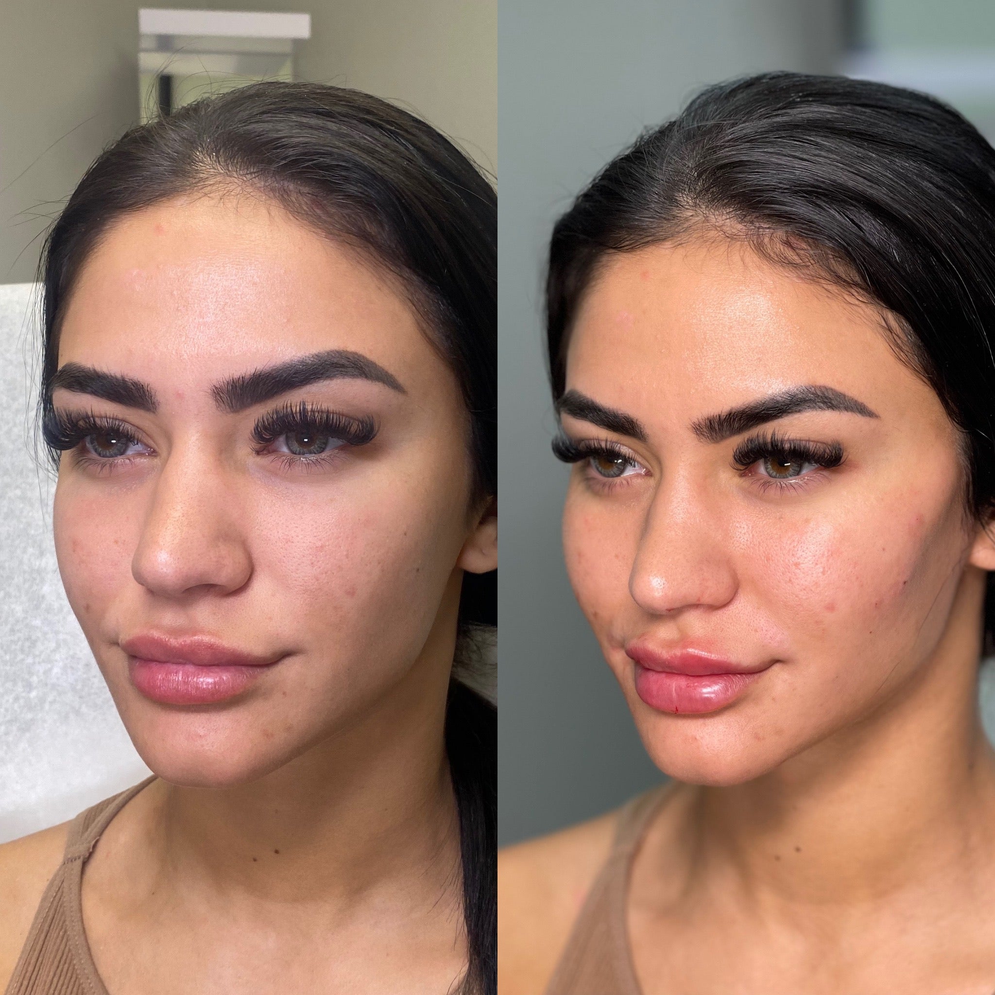 Cheek Fillers 2 ml – Volume, Lift & Facial Definition